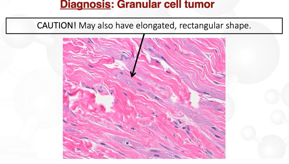 Janiranavarro's tweet photo. Breast - Granular cell tumor   

They are inhibin positive, maybe a better stain that CD68 
They are S100 and SOX10 positive CK and ER negative
  
Pitfall ⚠️
- They can look compressed/elongated (pic 3) instead of epithelioid like cells  
- They can look like muscle (pic 4)  

Dr. Cimino-Mathews #BreastPath #PathX #Pathtwitter #USCAP #pathology