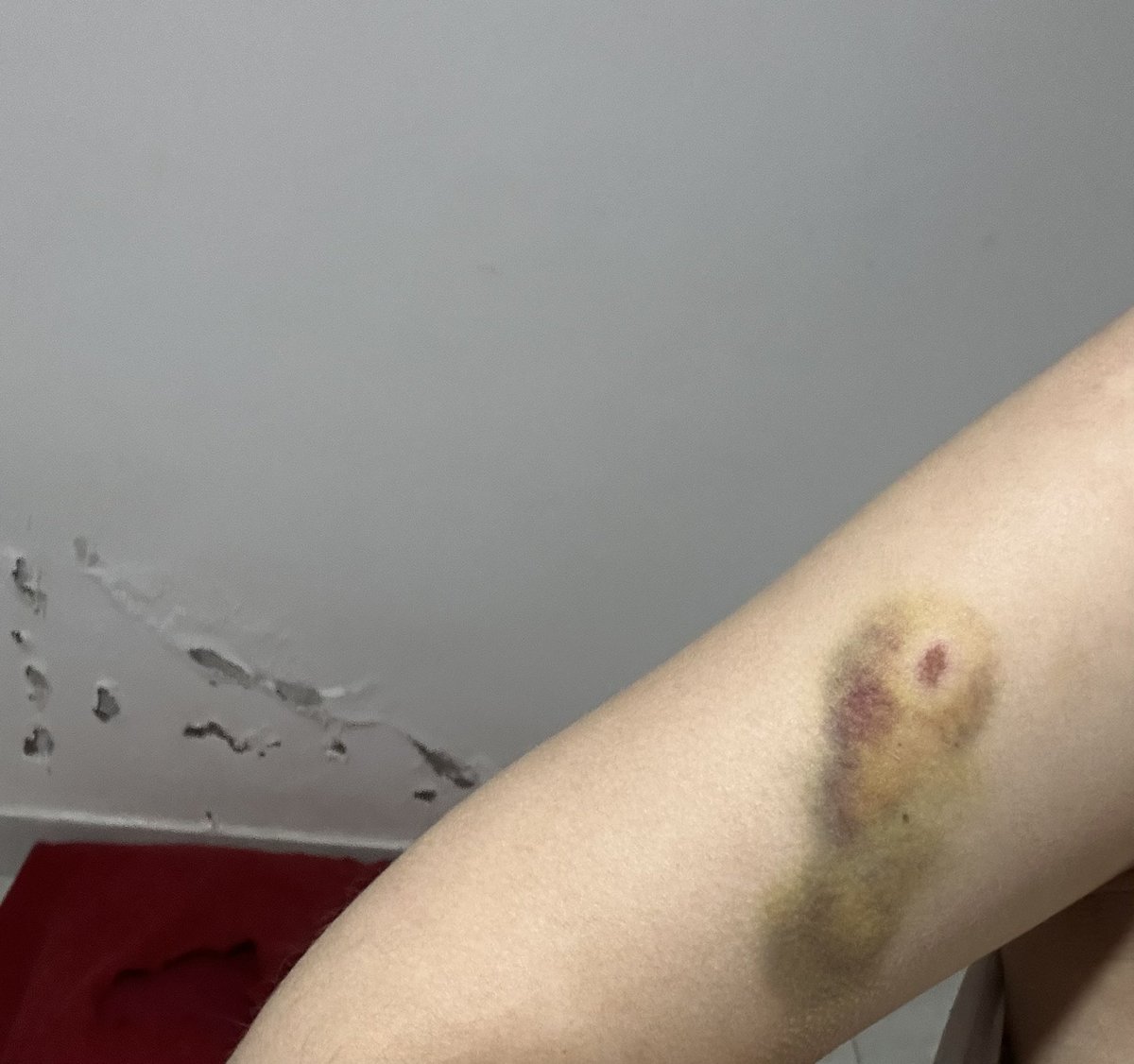 AgusGomezKPA's tweet photo. Hace un par de días mi perro me mordió el brazo sin querer y me quedó esta marca. Yo se que ustedes ven la forma, yo también. Elijo creer y anulo mufa https://t.co/G94o3fsjEL