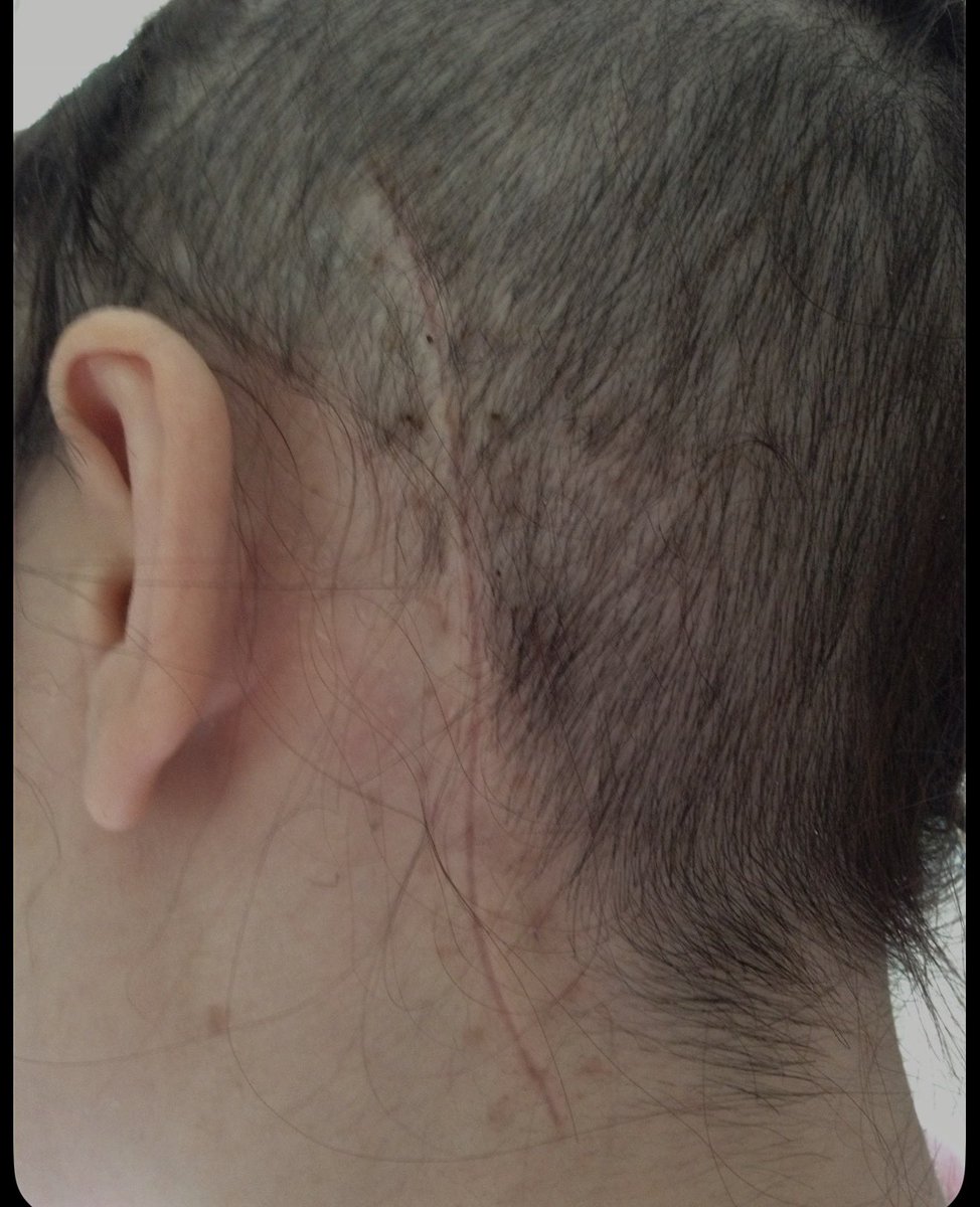 aboutasteph's tweet photo. 1. One week post craniotomy
2. Two weeks post craniotomy
3. Three weeks post craniotomy 

Pretty wild how well the human body can heal 🧠 

#craniotomy #braintumour #brainstem https://t.co/kyxk4bcMRD