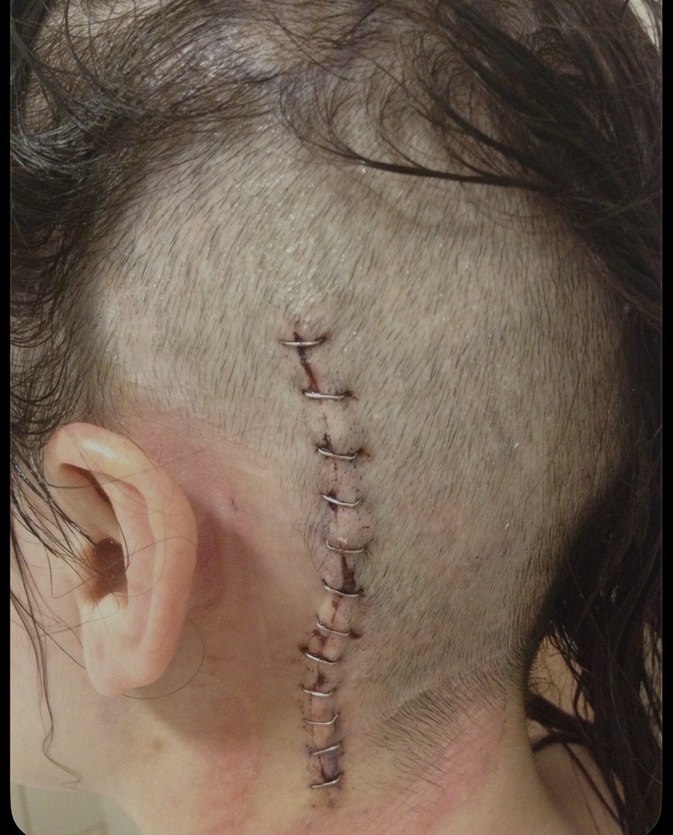 aboutasteph's tweet photo. 1. One week post craniotomy
2. Two weeks post craniotomy
3. Three weeks post craniotomy 

Pretty wild how well the human body can heal 🧠 

#craniotomy #braintumour #brainstem https://t.co/kyxk4bcMRD