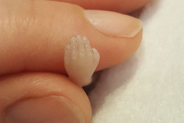 LifeNewsHQ's tweet photo. This is the hand of an aborted 15-week-old baby.

Abortion kills babies. https://t.co/jxGroja8xI