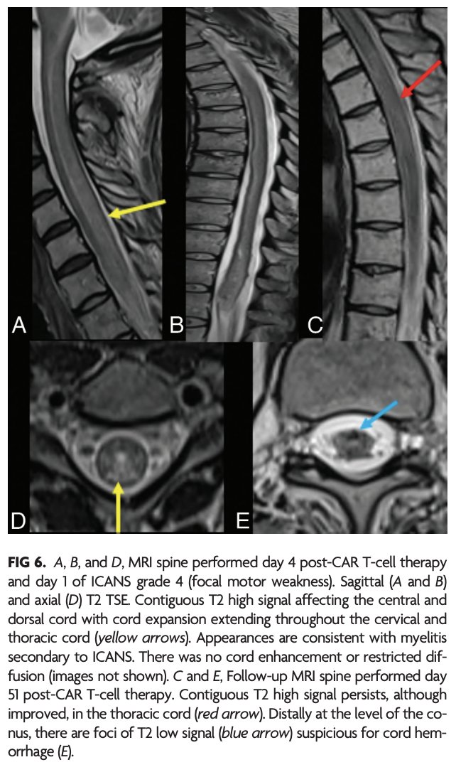 TheAJNR's tweet photo. AJNR Clinical Practice is excited to share its newest articles! 

Here is the featured article of the week: 
"A Review of Chimeric Antigen Receptor T-Cell-Related Neurotoxicity"

https://t.co/0TOoBuGNMp

#AJNRClinicalPractice @theAJNR_EIC https://t.co/r2hZmRyXD4
