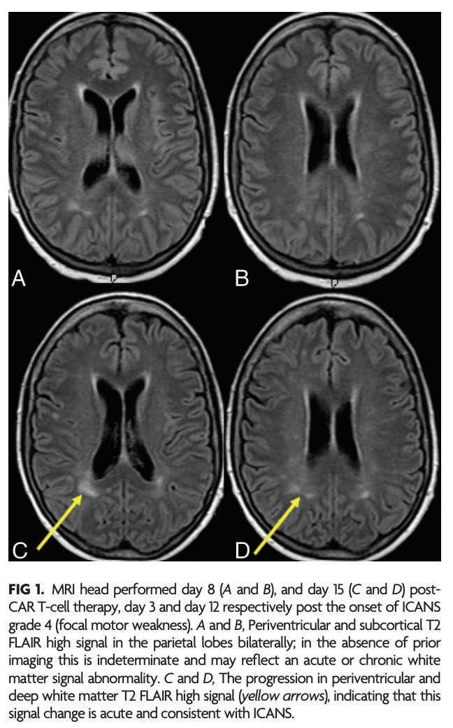 TheAJNR's tweet photo. AJNR Clinical Practice is excited to share its newest articles! 

Here is the featured article of the week: 
"A Review of Chimeric Antigen Receptor T-Cell-Related Neurotoxicity"

https://t.co/0TOoBuGNMp

#AJNRClinicalPractice @theAJNR_EIC https://t.co/r2hZmRyXD4