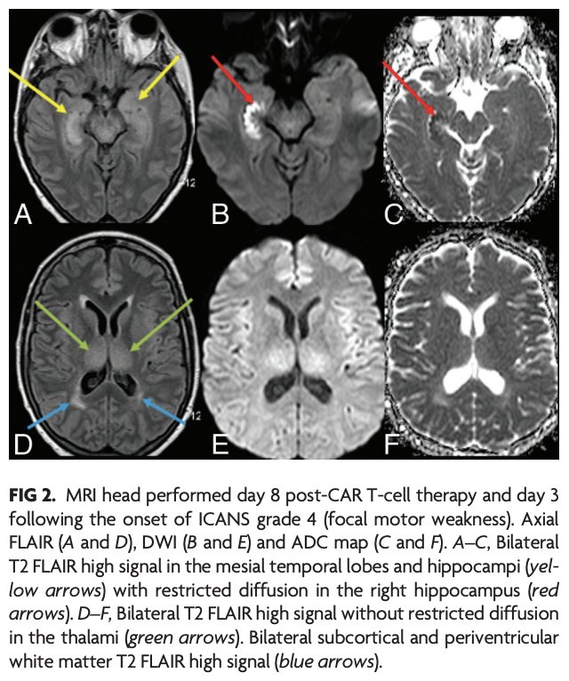 TheAJNR's tweet photo. AJNR Clinical Practice is excited to share its newest articles! 

Here is the featured article of the week: 
"A Review of Chimeric Antigen Receptor T-Cell-Related Neurotoxicity"

https://t.co/0TOoBuGNMp

#AJNRClinicalPractice @theAJNR_EIC https://t.co/r2hZmRyXD4