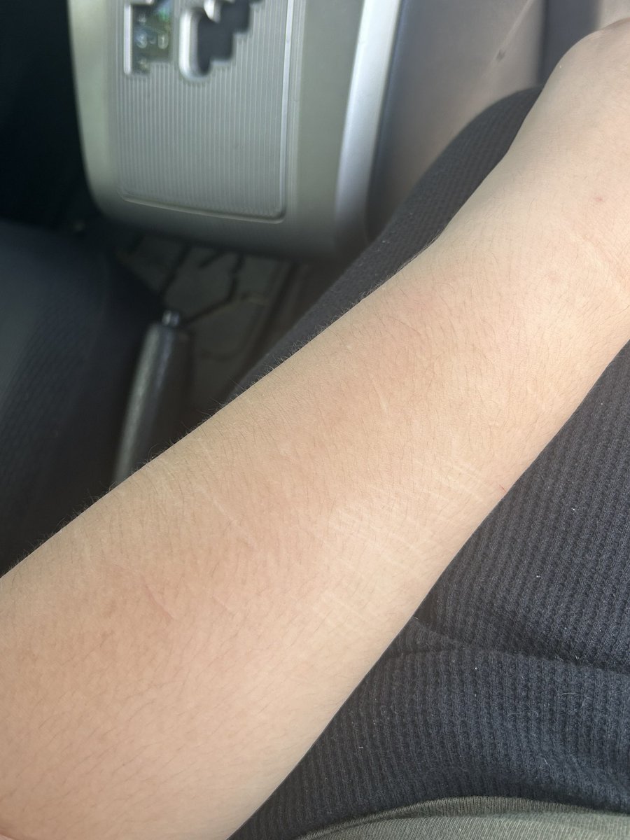 senniiso's tweet photo. Are my scars noticeable 
I feel like they are not as pretty as peak scarspo https://t.co/HPcuTiqlqa