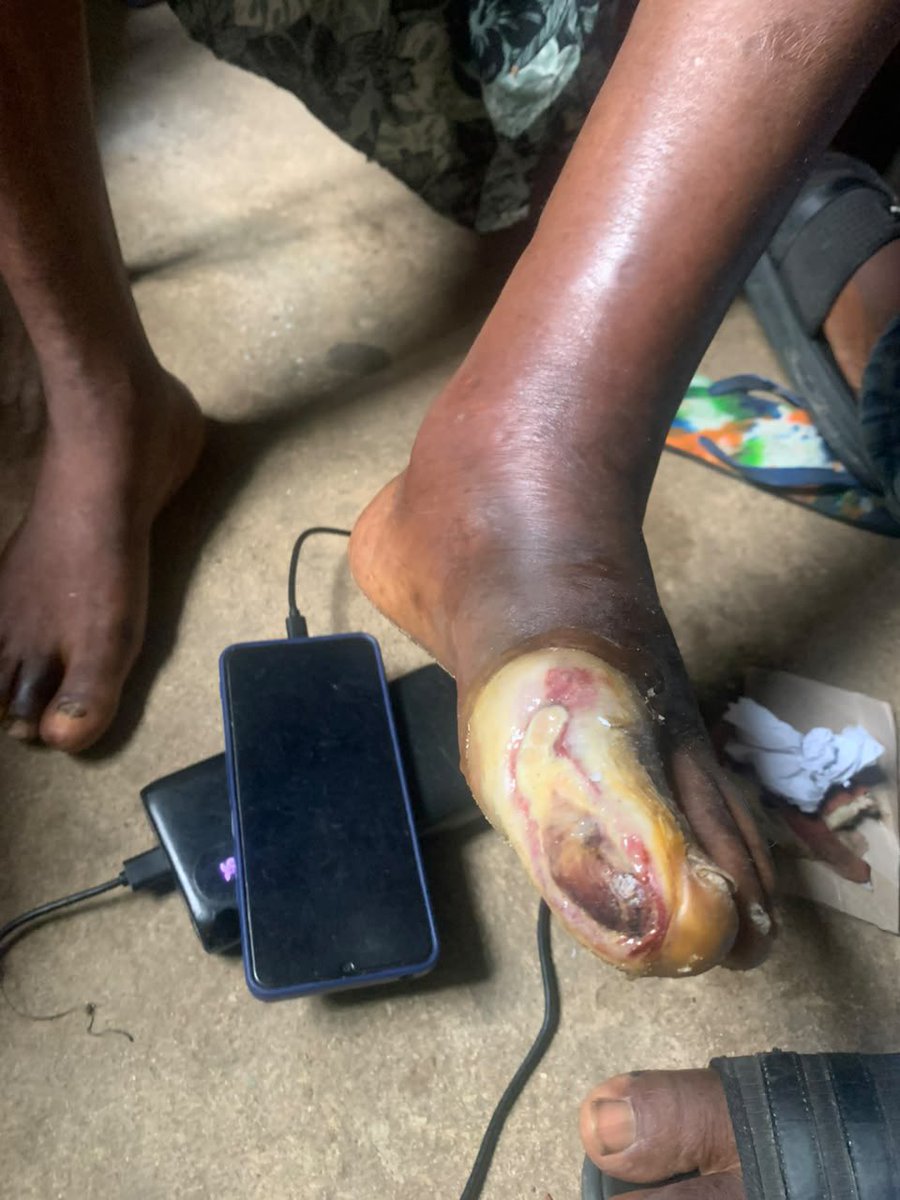Linokruiz_'s tweet photo. This is one of the hardest things I’ve ever had to write.

The woman in these pictures is my mother. A single mother of four, She has been battling severe diabetes, and her condition has worsened to the point where it has caused a serious wound on her foot. https://t.co/c1Hm8aXCkF