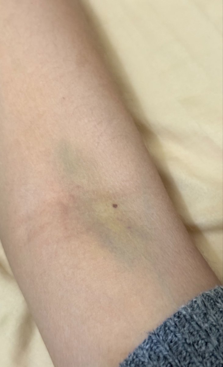 sachiitap's tweet photo. Actualización del brazo día (no me acuerdo cuál )

Ya no me duele tanto https://t.co/oJOtXG4HLt