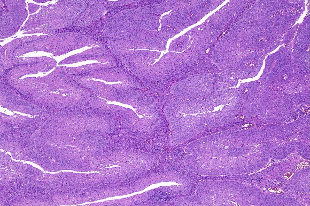 surgpathcases's tweet photo. Ovary, 60y

#pathology #patologia #gynpath #gynpathology https://t.co/WGh8ywv6fU