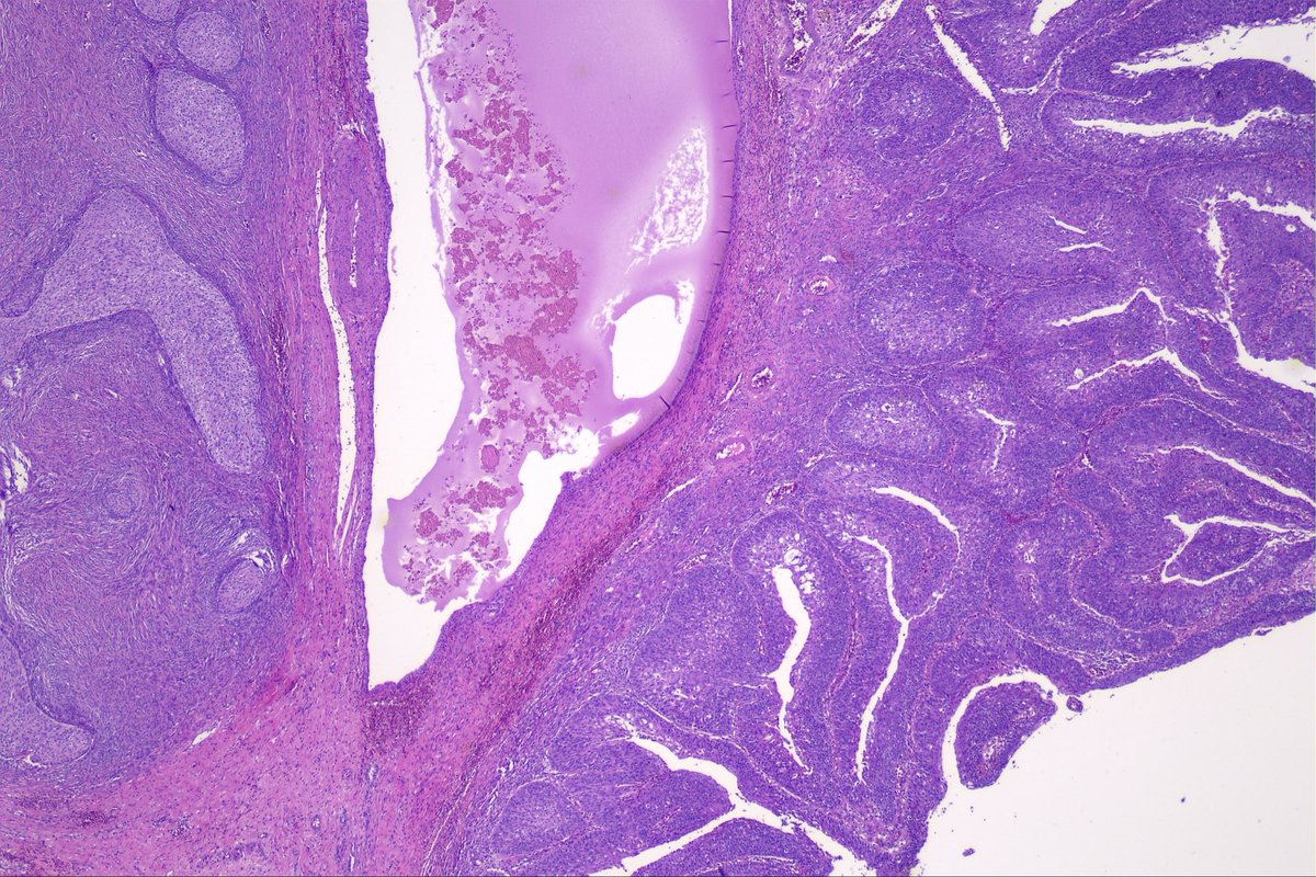 surgpathcases's tweet photo. Ovary, 60y

#pathology #patologia #gynpath #gynpathology https://t.co/WGh8ywv6fU