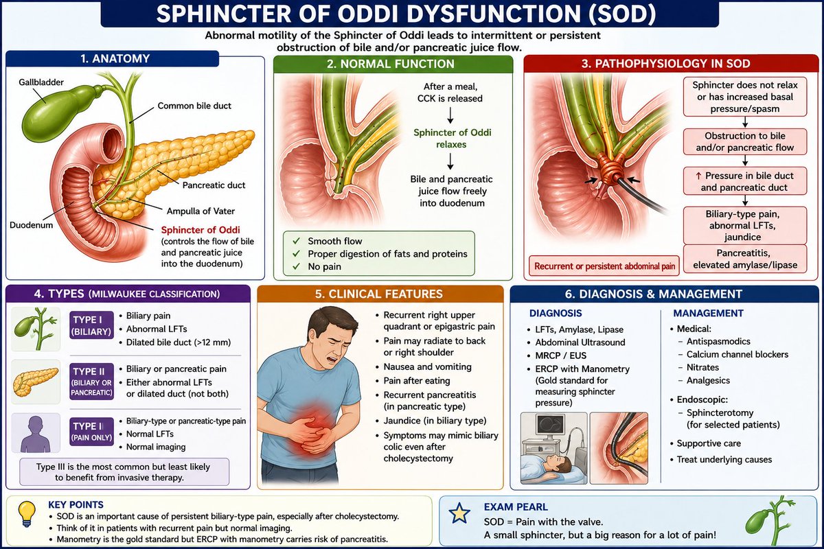 Dr_NUKOfficial's tweet photo. Today’s ward round introduced us to a patient with Sphincter of Oddi Dysfunction. Like a door that won’t open fully, it blocks the flow of bile and pancreatic juices, causing pain. A reminder that medicine is not just science, but also the art of caring for those affected.#SOD https://t.co/Q4XjcX1w9i