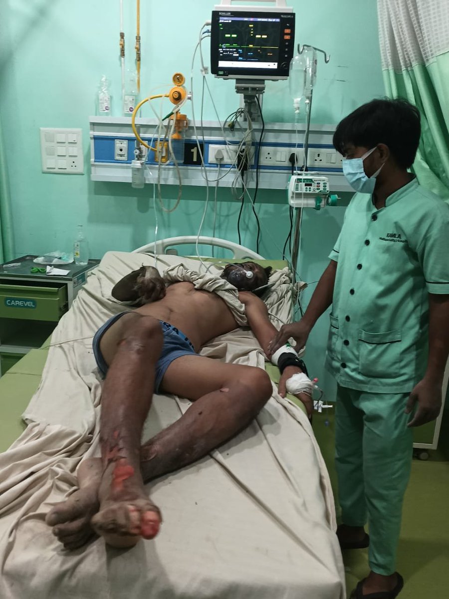 yadavamit_dev's tweet photo. 🚨 न्याय की गुहार: हाई टेंशन तार की चपेट में आने से ICU में जिंदगी की जंग लड़ रहा किसान का बेटा! 🚨

माननीय मुख्यमंत्री @myogiadityanath,  जी,@myogioffice @UPPCLLKO एवं जिला प्रशासन प्रयागराज से विनम्र अपील है कि ग्राम बेदौली (मेजा, प्रयागराज) के श्री जितेंद्र कुमार यादव के साथ हुई इस हृदयविदारक घटना का तत्काल संज्ञान लेकर निष्पक्ष जांच कराएं, दोषियों पर कठोर कार्रवाई करें तथा पीड़ित परिवार को इलाज का संपूर्ण खर्च उपलब्ध कराया जाए।

घटना का संक्षिप्त विवरण

📅 दिनांक व समय: 13 जुलाई 2026, प्रातः लगभग 9:00 बजे
📍 स्थान: ग्राम गुदनपुर के पास, ब्लॉक मांडा, जनपद प्रयागराज
⚠️ दुर्घटना: खेत जाते समय जमीन से महज दो हाथ ऊपर लटके 33,000 वोल्ट के हाई टेंशन तार की चपेट में आने से श्री जितेंद्र कुमार यादव गंभीर रूप से झुलस गए। वर्तमान में वे ICU में भर्ती हैं और जिंदगी की जंग लड़ रहे हैं।

प्रमुख मांगें

✅ दोषियों पर कार्रवाई: लापरवाही बरतने वाले जिम्मेदार अधिकारियों SDO अशोक कुमार, JE नमोनारायण, JE प्रशांत श्रीवास्तव एवं XEN अभिनव गर्ग के विरुद्ध कठोर कानूनी कार्रवाई की जाए।

✅ आर्थिक सहायता: पीड़ित के इलाज का संपूर्ण खर्च सरकार वहन करे तथा परिवार को ₹20 लाख का मुआवजा प्रदान किया जाए।

✅ सुरक्षा एवं रोजगार: भविष्य की सुरक्षा सुनिश्चित करने हेतु पीड़ित परिवार के एक सदस्य को सरकारी नौकरी दी जाए तथा पूरे मांडा क्षेत्र में हाई टेंशन लाइनों एवं बिजली के पोलों का तत्काल सर्वेक्षण एवं मरम्मत कराई जाए।

#JusticeForJitendraYadav #Prayagraj #UttarPradesh #UPPCL #ElectricalSafety #YogiAdityanath #Farmer