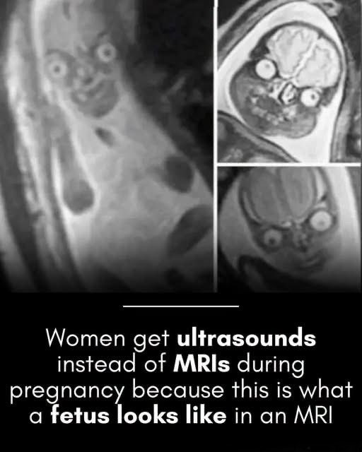 SmartScience's tweet photo. Why do women get ultrasounds instead of MRIs during pregnancy? This image may be some indication...

If you’ve ever seen a prenatal magnetic resonance imaging (MRI) scan, you might have been startled. Unlike the soft, grainy, and reassuring shapes of a standard ultrasound, fetal MRI scans can make a developing baby look remarkably like a spooky, wide-eyed alien from a science fiction movie. 

These bizarre, skeletal-looking images have gone viral multiple times, sparking jokes and a bit of horror online. While the 'ghoulish' grins are actually just a natural result of how MRI technology captures organs and tissues with high water concentrations, they highlight a deeper question about prenatal care: why do doctors rely so heavily on ultrasounds rather than MRIs?

The answer comes down to safety, cost, and practicality. Ultrasound technology is highly safe, non-invasive, and incredibly cost-effective, typically costing several hundred dollars compared to an MRI, which can cost thousands of dollars. Ultrasounds are perfect for routine checkups, allowing doctors to easily monitor fetal growth, amniotic fluid, and the placenta. 

However, MRIs are not entirely obsolete in pregnancy. If a standard ultrasound reveals a suspected anomaly—especially within the fetal brain or other complex soft tissues—doctors will call for a fetal MRI. Because MRIs offer a larger field of view and superior soft-tissue contrast, they act as an invaluable secondary tool to help parents and medical teams prepare for any potential complications before birth.

source: Dapcevich, M. (2022). Do These Images Show MRIs of Fetuses? Snopes.