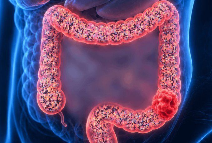 YosuepEstebanX's tweet photo. Científicos coreanos acaban de descubrir cómo revertir el cáncer de colon.

 Lograron transformar las células cancerosas en células sanas del colon sin quimioterapia, cirugía ni radiación. 

Aquí te explicamos cómo funciona (y cómo limpiar tu colon). https://t.co/9fo7aFLN0E
