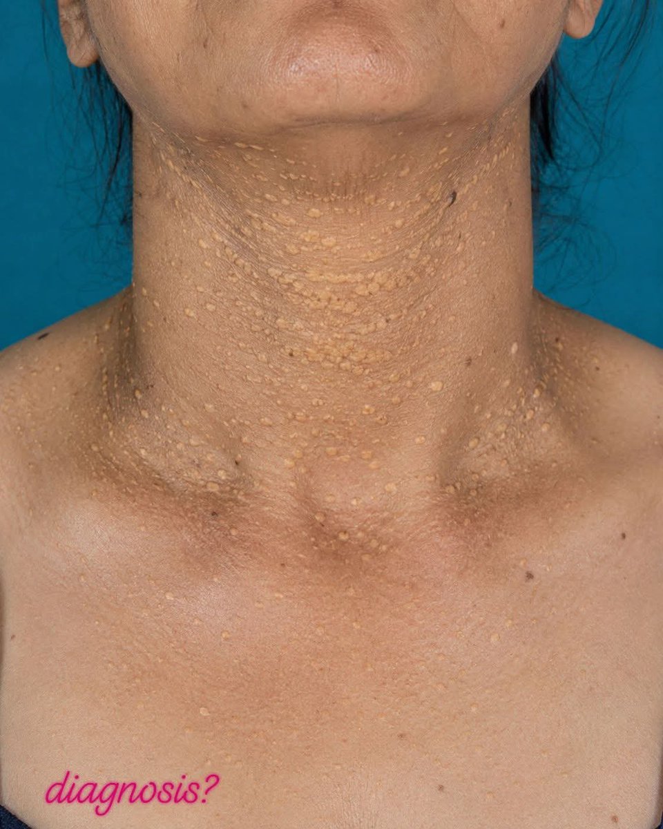 albertoortegana's tweet photo. Can you identify this inherited connective tissue disorder? What clinical clue gave it away? 👇 https://t.co/RU0QFtLUvy
