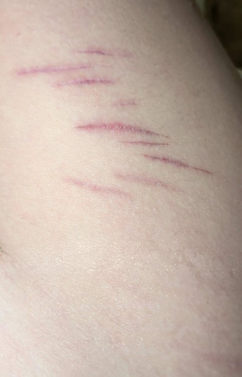 No20171No's tweet photo. I miss when these were newer, they're mostly faded now since I've tanned. 

please don't mind the hair. #shtwt #slittwt https://t.co/GSxN8VWKxW