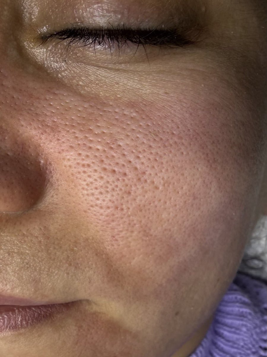 Mastering_life_'s tweet photo. How can I get rid of these pores? https://t.co/3jAlhBVD3p