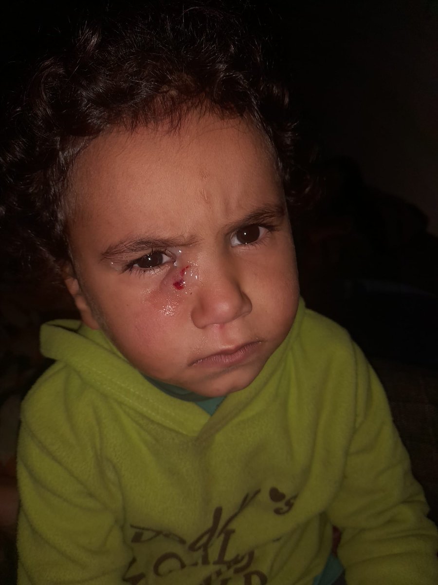 DalulainGaza's tweet photo. I don't know what bit my poor daughter Rosette. She's in so much pain. Life here is harsh—strange😱 insects and rodents, and it's dark. We have no light to see what's happening around us. Please look upon us with mercy. I want to buy a flashlight😰 

https://t.co/MfwQOKJDkb https://t.co/1jvUxSe89Y