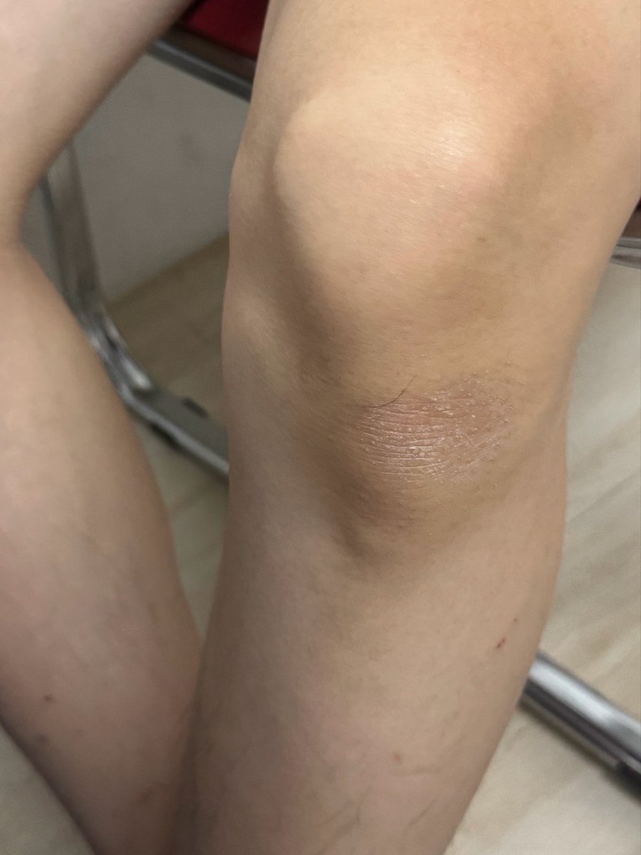 hbker07's tweet photo. นี่ไม่ตัดเล็บเท้าเองเลย
1. ตัดเองแล้วทรงไม่สวย เท้าดูนิ้วกุดๆ ทรงเล็บอุบาดมาก
2. ตัดเองบางทีเผลอเข้าลึกไป เล็บขบอีก
โอ๊ยจะบ้าตาย ตั้งแต่รู้จักสิ่งที่เรียกว่าสปาเท้า คือไปทำตลอดเลย ให้พี่ช่างดูแล ขัดให้ ตะไบให้ แล้วก็ตัดเล็บให้ สวยย
ล่าสุดน้องชายเข่าด้าน ชอบคุกเข่าทำงานที่พื้น พาไปทำสปามา พี่ช่างขัดแล้วก็มาสก์ให้ถึงเข่าเลย ทำเสร็จเข่าหายด้านทันที (แต่ก็ต้องไปทำซ้ำนะ) 55555 ใครเข่าด้าน เท้าด้าน มีรอยรองเท้ากัด หรือตาตุ่มด้าน จองคิวทำสปาเท้าด่วน ฟินมาก