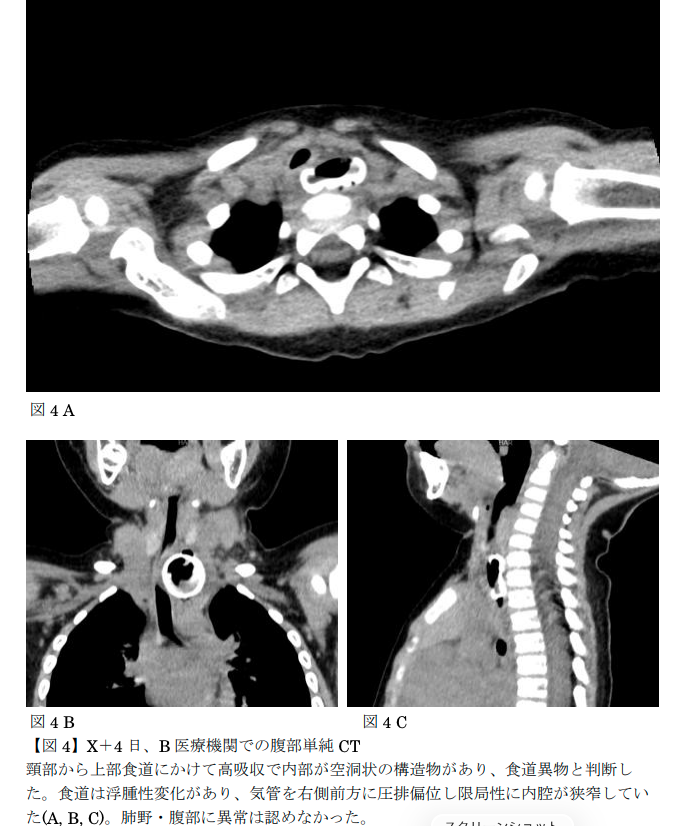 AoringoDr's tweet photo. 【Injury Alert No.23 類似事例】
🎮️「ゲームコントローラーのスティックカバー」の誤飲によって、小さな子どもが全身麻酔での摘出術を経験した事例が報告されています。 

🎮 何が起きたの？
・1歳2か月の男の子が、ソファに置きっぱなしだったゲーム機を発見。 
・スティック部分を噛んだ拍子に、シリコン製のカバーが外れて誤飲してしまいました。 
・水やゼリーは飲めるのに、固形物を食べると吐いてしまう状態が続き、入院へ。 
・最終的に、全身麻酔下で内視鏡を使って食道から異物を摘出することになりました。

⚠️ ここが怖いポイント！
・このカバーはシリコン製だったため、最初のレントゲン検査では明らかな異物として写りませんでした。
・数日後のCT検査で、ようやく食道に詰まっていることが判明しています。 
・台所で洗い物をしながら見守っていても、一瞬の隙に起きてしまうのが誤飲の恐ろしいところです。

🍎この時期の子どもは目についたものを何でも口に入れて世界を探索します。ピアジェの発達段階でも見られるごく自然な行動だからこそ、大人の環境づくりが命綱になります。

💡 今日からできる対策
・上の子のおもちゃやゲーム機は、使い終わったら必ず「手の届かない場所」へ片付けるルールを徹底する。 ・「トイレットペーパーの芯」を通るサイズのものは、すべて誤飲・誤嚥の危険があると認識する。

🍎「ちょっと目を離した隙に…」は、どんなに気をつけていてもどの家庭でも起こり得ます。
悲しい思いをする子どもとご家族を減らすためにも、ぜひこの情報をリポストで広めてもらえると嬉しいです！

参考）Injury Alert (傷害速報)類似事例 ゲーム機用スティックボタンカバー誤飲による食道異物（No.23 イヤホンのパーツの誤飲 による食道異物の類似事例 8）