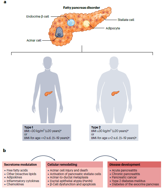 scottisaacsmd's tweet photo. Fatty pancreas disorder is classified into type 1 (without obesity) and type 2 (with obesity), both representing an early organ-specific state that reshapes the pancreatic secretome and cellular architecture and can drive pancreatitis, diabetes and pancreatic cancer.
https://t.co/pk3xmTMT4t