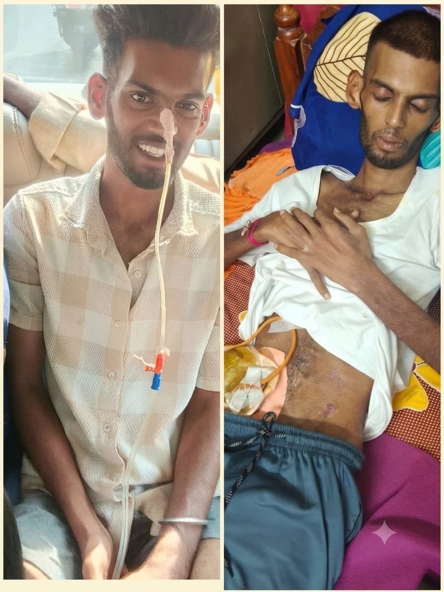 SureshGundapu21's tweet photo. 🚨 URGENT: నా స్నేహితుడు సిద్ధు ప్రాణాపాయ స్థితిలో ఉన్నాడు. 45 రోజుల్లో 2 సర్జరీలు (Stoma), రక్తాన్ని కమ్మేసిన ఫంగస్. 36Kg కి పడిపోయాడు. మూడో సర్జరీకి మీ సాయం కావాలి! 🙏
​💸 UPI: 918331868062
🌐 Reports: https://t.co/0dzUJIZYOX
​@KTRBRS @SonuSood https://t.co/4nU3U9nIPG