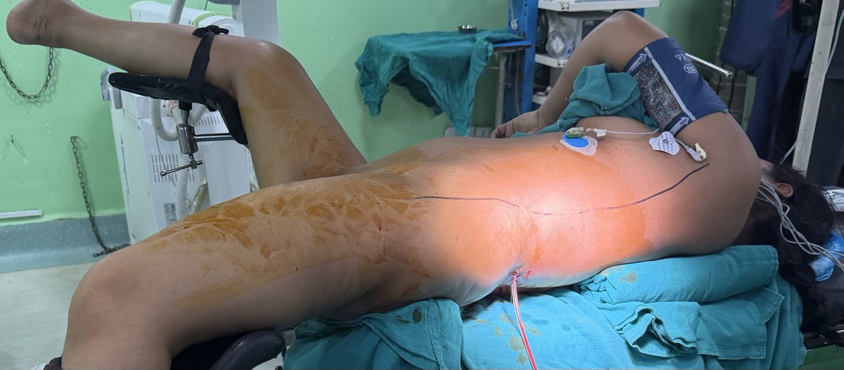 PrajwalPaudyal's tweet photo. Replaced an intraperitoneal nephrostomy tube that had perforated the renal pelvis with a correctly positioned PCN. https://t.co/QKTfUTzUxo