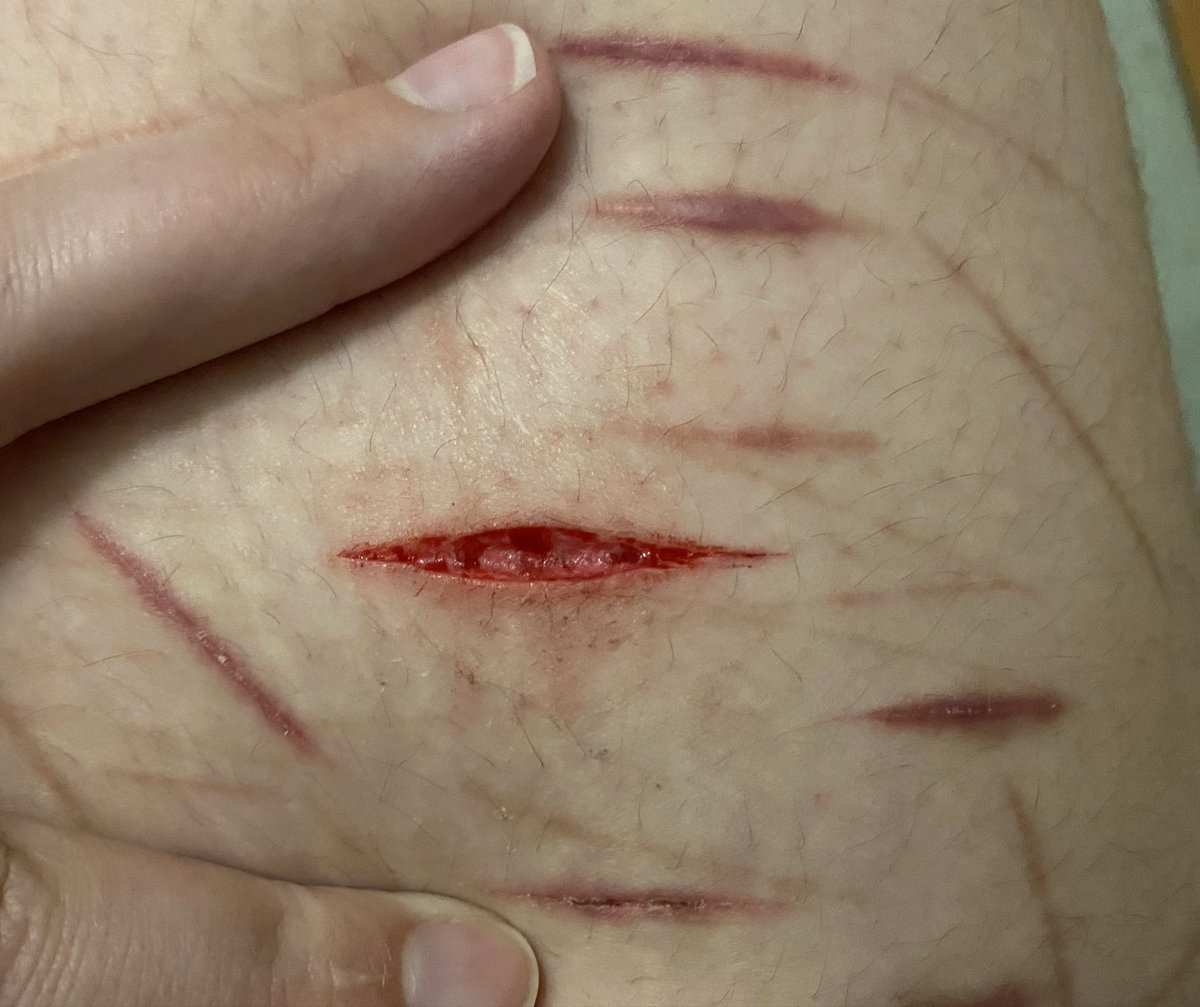 DimiMoozy's tweet photo. One singular deep styro. How lonely. I’ll give her more friends once I go buy more bandaids. Used my last ones on her.

#shtwt #sh #slittwt #cut #shedtwt https://t.co/91HyyxOpKx