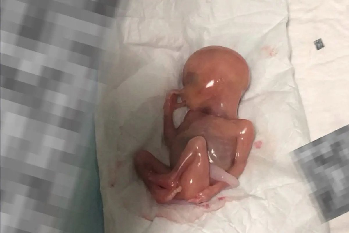 masvidaoficial's tweet photo. Samuel fue abortado a las 16 semanas. 
Vivió 30 minutos fuera del vientre. 
Murió chupándose el dedo.
Esto no es salud pública.
Es cruel e inhumano. https://t.co/SDiuAIJ7QF