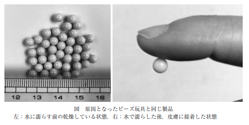 AoringoDr's tweet photo. ⚠️小さなお子さんがいる親御さんへ拡散希望
【Injury Alert No. 116：ビーズ玩具による外耳道異物・鼓膜穿孔】

水でくっつく「ビーズのおもちゃ」、本当に気をつけてください。耳に入ると、最悪の場合「全身麻酔」での摘出が必要になる大事故に繋がります。

📝 どんな事故？
・4歳の男の子が、直径5mmのビーズを耳に入れてしまいました。
・救急外来を受診したものの、ビーズが耳の奥にはまって激痛を伴い、そのままでは摘出不可能に。
・最終的に鎮静剤（麻酔）を使用し、癒着と出血と闘いながら1時間かけてようやく摘出されました。
・結果として「鼓膜穿孔（鼓膜の破れ）」を合併する事態となっています。  

📝怖いのは、このおもちゃの「水でくっつく」という性質です。
・このビーズ（PVA製）は、耳の中のわずかな水分に反応し、乾燥する過程で周囲の皮膚や鼓膜に「強力に接着」してしまいます。  

🚨 もし耳に入れてしまったら？絶対にやってはいけないこと
❌ 家庭で無理に取ろうとする
❌ 水で洗う・点耳薬を使う（水分でさらに強力に接着してしまいます！） 

もしお子さんが耳に入れてしまったら、何もせず、速やかに医療機関を受診してください。

🍎遊ぶときは保護者が見守り、小さなきょうだいの手の届かない場所で保管することが鉄則です。 
大切な子どもたちを思わぬ事故から守るため、ぜひ周りのパパママにもこの事実を教えてあげてください！