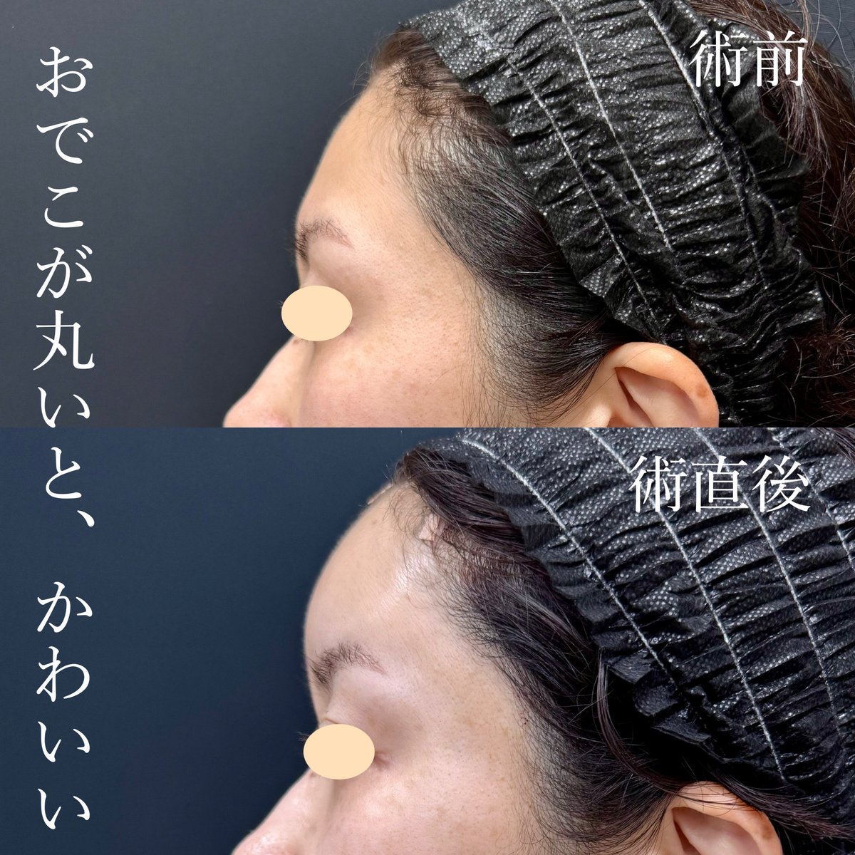 sbc_takesako's tweet photo. 加齢とともに骨も筋肉も脂肪も萎縮する為、額は凹み、ごつごつします。
ゆっくり凹んでいくので、毎日自分の顔を見ていると、恐ろしいことにこの凹みが進行していることに気づかないのです。
凹みを脂肪注入で埋めてあげると、10年前の自分のおでこにタイムスリップできます。 https://t.co/h8xKL8mHOd