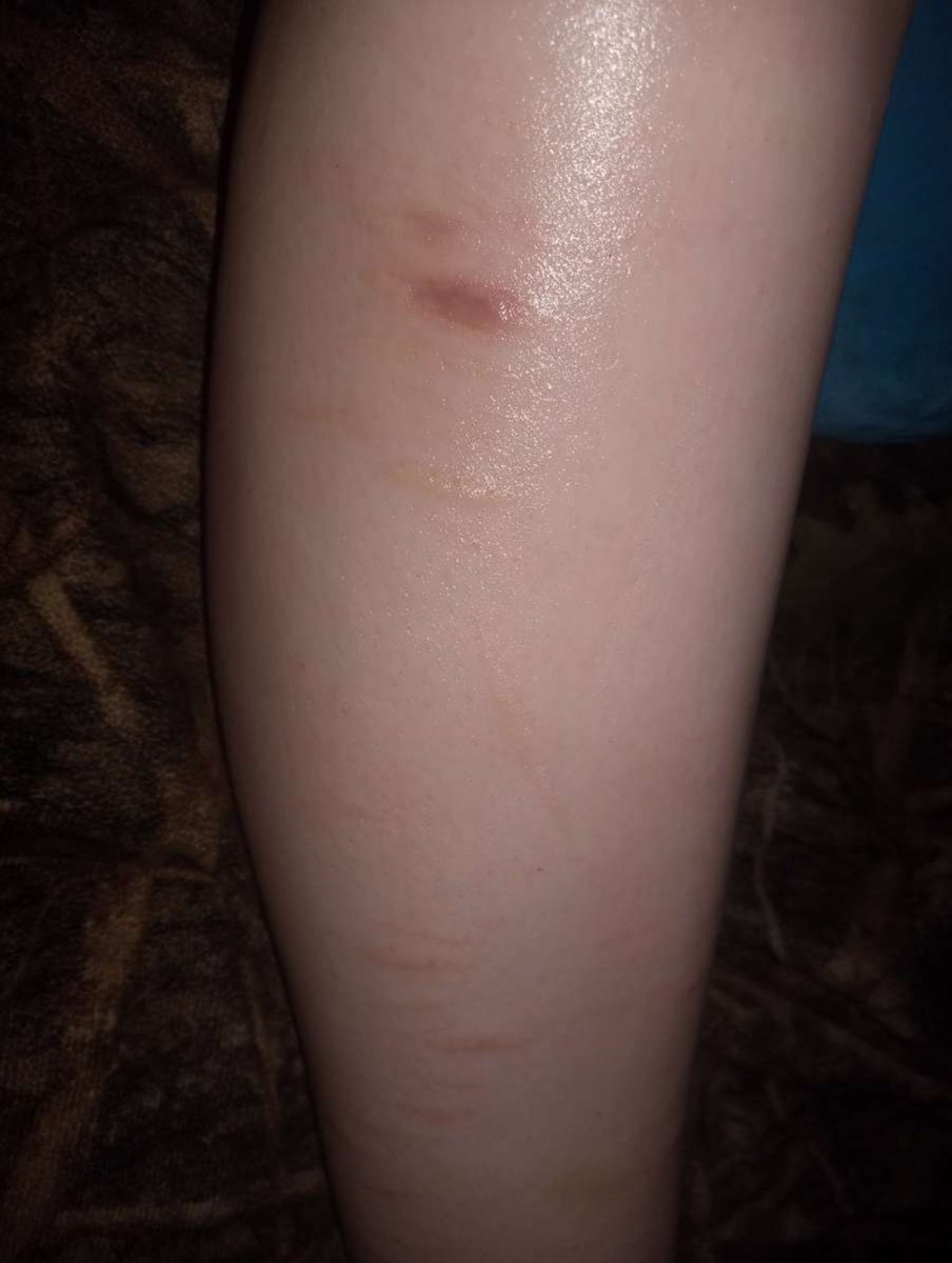 Littlelamb505's tweet photo. My fatass legs and their scars ignore how shiny I am https://t.co/4sFfNpyIIM