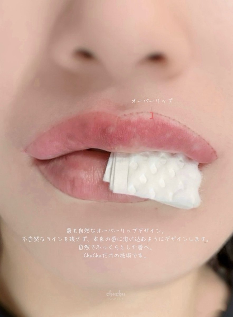 chuchu_artmake's tweet photo. 自然にぷっくり、でもバレない。

オーバーリップでも、不自然なラインは残しません。

本来の唇に溶け込むようにデザインし、
自然な立体感と血色感をプラス。

韓国式グラデーションリップで、
すっぴんでも可愛く見える唇へ。

一人ひとりのお顔に合わせて、
最も自然なオーバーリップをご提案します。💋

ご予約・ご相談はプロフィールのLINEからお気軽にどうぞ。

𖦹 . ⋆ ° ⊹ ｡ ⋆  ᰔ ⋆ ｡ ⊹ ° ⋆ .  𖦹 

🍃人中短縮×小鼻効果
🍃じんわりリップ
🍃ぽってりM字リップ
🍃整形級

🎀 施術項目
・リップアートメイク
・眉アートメイク
・アイライン
・涙袋アート
・ヘアライン

𖦹 . ⋆ ° ⊹ ｡ ⋆  ᰔ ⋆ ｡ ⊹ ° ⋆ .  𖦹

※ 少人数制でのご案内となります。
🔖初回 ¥5,000 OFF

👩‍⚕️KC・ISO認証色素を使用しています。
👩‍⚕️滅菌済みの使い捨て器具で、安全に施術しております

📍 韓国・日本 全地域出張可能です ✈️
📲 ご予約・ご相談はプロフィールのLINEより

 #リップデザイン #唇アートメイク #東京アートメイク #韓国美容 #韓国旅行