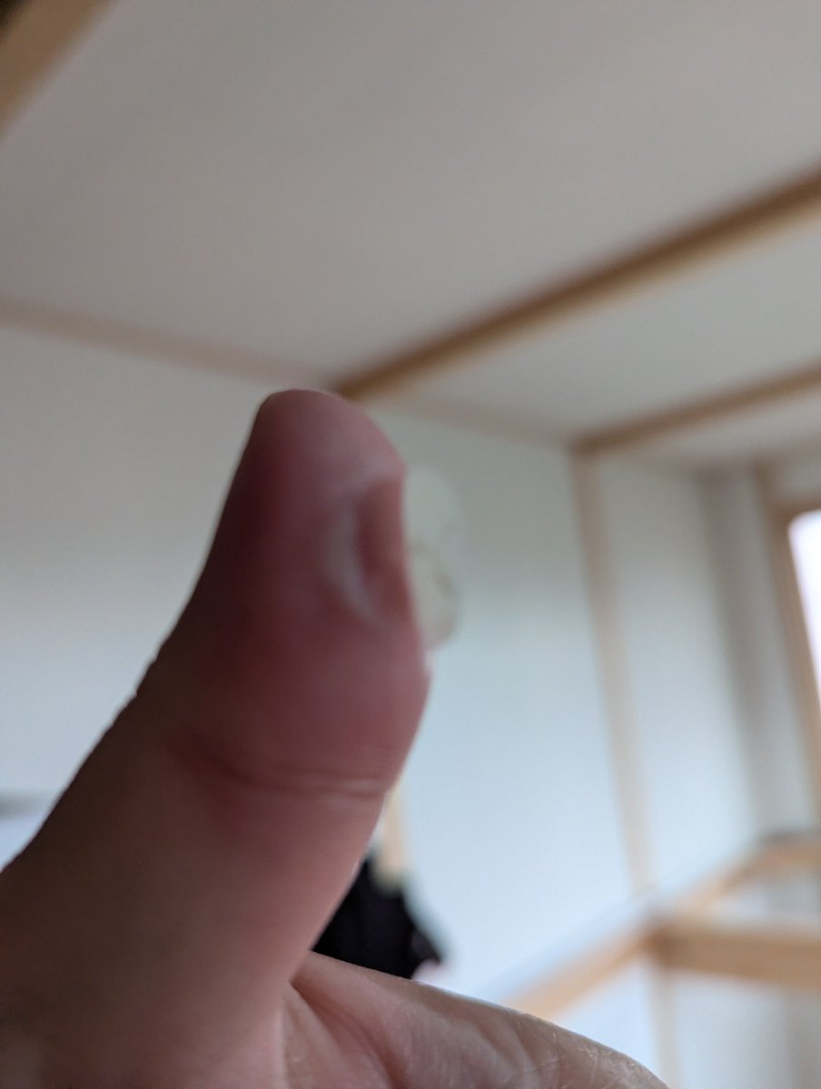 hatuobaba's tweet photo. 2週間ほど前に火傷した親指が今ごろになって…風呂掃除でブラシ握ってたら皮むけました😆
下にね新しい皮あって痛くないよー👏 https://t.co/nKhJI2oViw