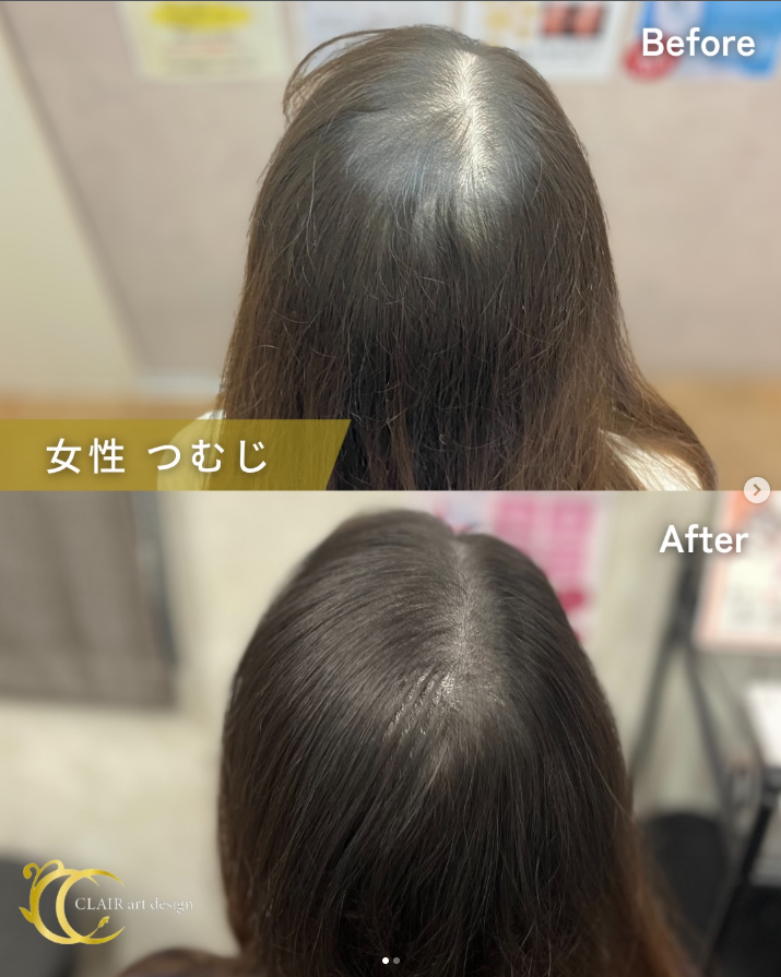 ClairClinic's tweet photo. 後ろ姿って、自分ではなかなか確認できないので不安🫨
という方は意外と多いです。

特に、
「つむじや分け目の地肌が思ったより目立っていた…」
というケースも少なくありません。

みなさんは、後ろ姿に自信はありますか？👀

頭皮アートメイクは、地肌の透け感を目立ちにくくし、自然な印象へ導く施術です✨

「人から見られる後ろ姿が気になる」
そんなお悩みがある方は、ぜひ一度ご相談ください😊