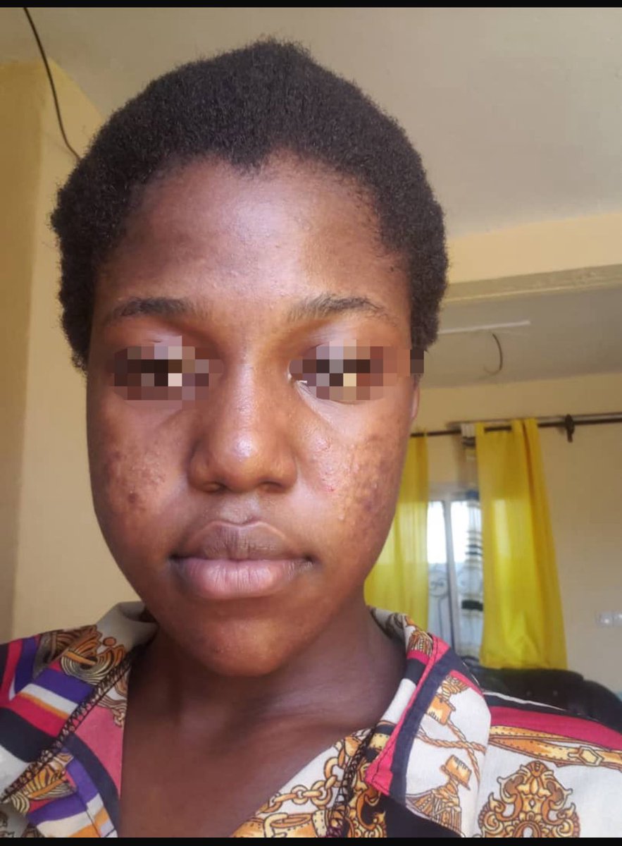 Eveboo9's tweet photo. First frame: BEFORE 
Second frame: AFTER 

Do you need help with your skin?
Fungi acne, dark spots, uneven skin tone etc 

Kindly send a dm or click the link in my Bio for consultation. 

My client might be on your timeline 
Please spare some your time and retweet. https://t.co/ED8v4e4SUc