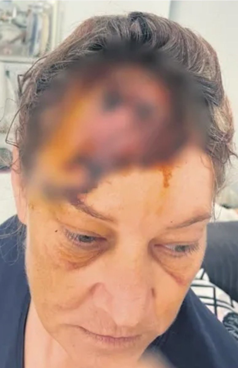 GEBETETV's tweet photo. Emekli Kadın Polisin başına gelenler ‘İnsanlık Ölmüş’ dedirtti

İzmir’de ISONEM boyalarının Yönetim Kurulu Başkanı Kubilay KURT’un sahibi olduğu Amerikan Akita cinsi köpek, Emekli Polis Ümran MERTTÜK’e saldırdı

Kafasına 80 dikiş atılıp vücudunun çeşitli yerlerinden yara alan Ümran Hanım, Kubilay KURT tarafından tüm masraflarının karşılanacağı taahhütünü alsa da, aylar süren tedavi masrafları, psikolojik ve fiziki yıpranmalar sebebiyle zor zamanlar geçirdiğini ve yalnız bırakıldığını iddia ederek şikayetçi oldu. 

SAHİ, İNSANLIK ÖLDÜ MÜ ?

@izmirvaliligi @EmniyetIzmir @izmir @izmirgibiyiz @izmirdecevirmee @izmirgundemcom