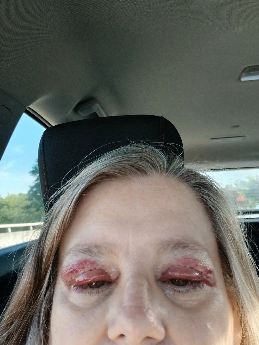 UDarnTuten's tweet photo. Post op day 3 .a little sore, more like a bee sting.probably one of my stitches but nothing bad not enough to keep me from going to church this am. #blepharoplasty https://t.co/09Idmum4yG