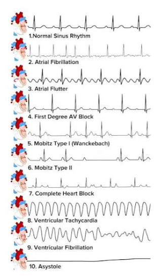 HarrySpoelstra's tweet photo. C0VID-19/LongC0vid and potentially dangerous Cardiac Arrhythmia

🚨What the data show for 2026, a personal rough recap:

COVID-19 and LongC0vid significantly elevate arrhythmia risks, with reinfections adding cumulative damage via repeated inflammation and vaccination offering partial protection by reducing severe outcomes.

➡️Acute phase (hospitalized/ICU):
- Overall arrhythmia prevalence reaches ~17% generally and 44–46% in ICU/hospitalized patients,
- New-onset atrial fibrillation (AF) occurs in 5–10% of hospitalized cases (higher in severe/ICU), strongly linked to elevated in-hospital mortality,
- Ventricular arrhythmias range 0.1–8%,
- Sinus tachycardias are common,
https://t.co/s9GfaUcT4l

➡️LongC0VID (post-acute >30 days):
-  A 2026 meta-analysis of 14 large studies found significantly higher risks across all major types:
✴️Atrial fibrillation: +49% (HR 1.49),
✴️Ventricular arrhythmias: +72% (HR 1.72),
✴️Sinus tachycardia: +69% (HR 1.69),
✴️Sinus bradycardia: +58% (HR 1.58),
- Risks were clearly higher after severe infections,
- Reinfections add cumulative damage,
https://t.co/vYvjJ9FSMn

➡️Cardiovascular impact:
- Acute AF/arrhythmias raise mortality, ventricular arrhythmias can be lethal,
- Long-term impact:
Higher risk of heart attack, stroke, and heart failure, plus ongoing rhythm problems, including potentially lethal ventricular arrhythmias,
- Overall, with reduced quality of life,
https://t.co/ZVlN5mqQ4N

➡️Reinfections & vaccination:
- Multiple infections compound long-term cardiovascular and LongC0VID risks, likely amplifying arrhythmia susceptibility through cumulative effects,
- Vaccination(-updated) reduces severe disease and post-COVID arrhythmic burden (e.g, lower ventricular ectopy),
https://t.co/nuQo0fFT1o

‼️So, COVID-19 leaves a lasting mark on the heart’s electrical system. Even after recovery, LongC0VID raises the risk of serious arrhythmias by 49–72% across major types (AF, ventricular arrhythmias, sinus tach/brady), with reinfections adding cumulative damage. Vaccination(updated) should offer meaningful protection by lowering severe outcomes and post-infection arrhythmic burden.
These risks are real, measurable, still highly relevant in 2026 and sadly, for years to come!
#YouOnlyHaveOneHeart #AvoidSars2 #AvoidReinfections #Mitigation