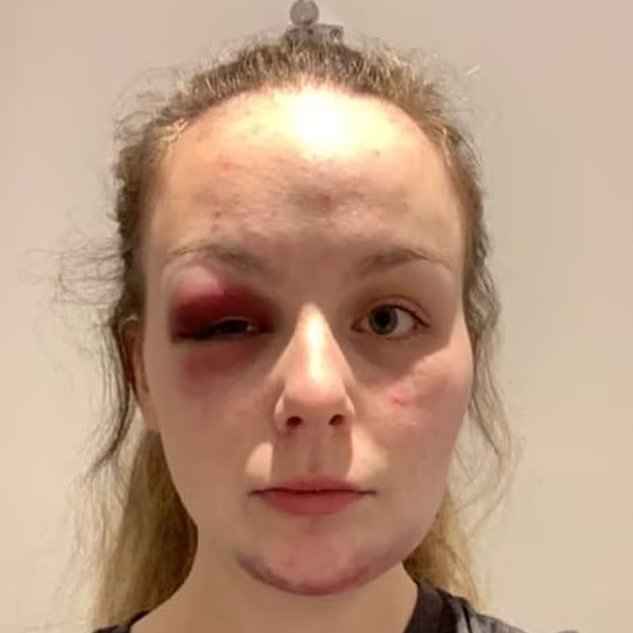 Cultination1's tweet photo. 🏴󠁧󠁢󠁥󠁮󠁧󠁿🚨⚠️Elle affirme avoir été victime de VIOLS et de VIOLENCES commis par plusieurs hommes... pourtant tout n'était qu'une INVENTION.

En 2020, Eleanor Williams, une jeune femme de Cumbria, en Angleterre, fait la une des médias après avoir affirmé avoir été victime de VIOLS et de VIOLENCES commis par plusieurs hommes.

Elle publie sur Facebook des photos montrant des blessures qu'elle présente comme des PREUVES des AGRESSIONS subies. Ses accusations provoquent une importante réaction publique et une enquête policière est ouverte.

Après plusieurs mois d'investigation, les autorités concluent que son récit était largement FAUX. Les enquêteurs découvrent qu'elle avait FABRIQUÉ certaines preuves, notamment des blessures qu'elle se serait infligées elle-même.

Plusieurs hommes avaient été accusés publiquement et certains ont SUBI de graves conséquences personnelles. En 2023, elle est reconnue COUPABLE de perversion du cours de la justice et condamnée à 8 ans de prison.
(Le Parisien)