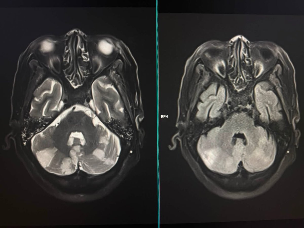 DrAyubaD's tweet photo. Head trauma and unconscious for 3 days now .
What are your thoughts ? More images in the comment section👇👇.
#MedX #FOAMrad #Radiology #Neuro https://t.co/GH3n4RDhpq