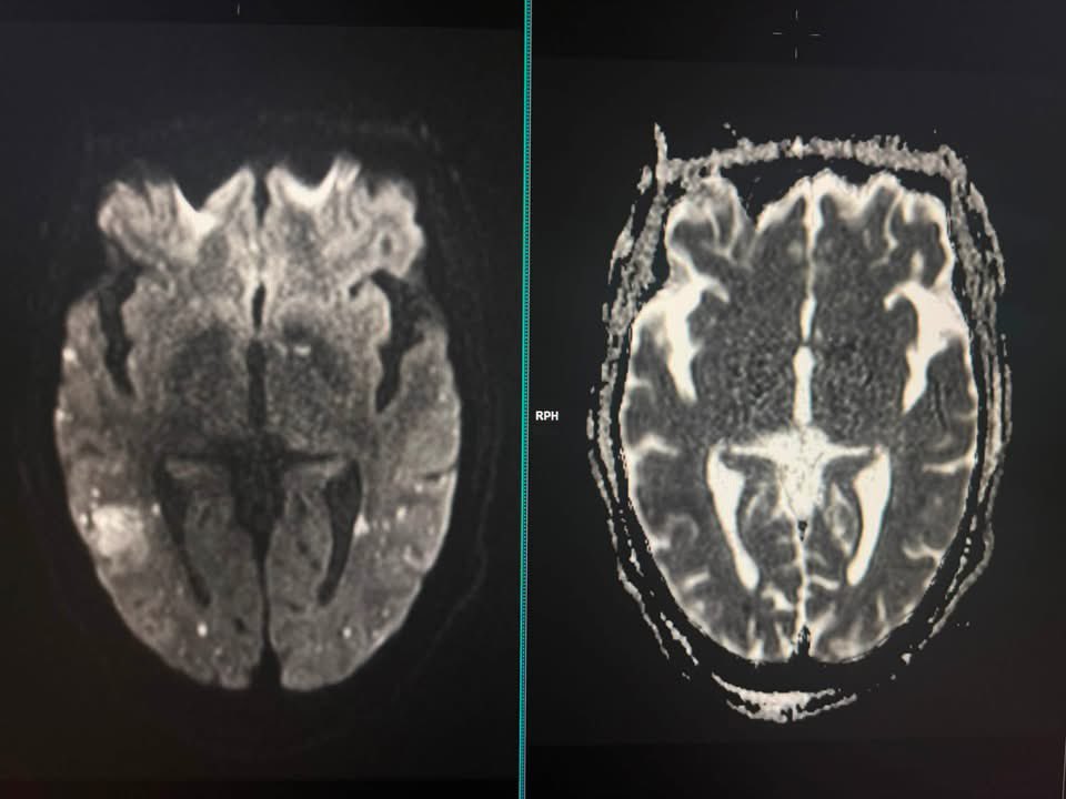 DrAyubaD's tweet photo. Head trauma and unconscious for 3 days now .
What are your thoughts ? More images in the comment section👇👇.
#MedX #FOAMrad #Radiology #Neuro https://t.co/GH3n4RDhpq