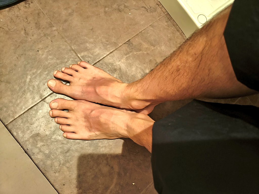 asahi_jm's tweet photo. 海帰りに #チームラボ　からの
ヤケすぎて痛い🤕焼け方な…w https://t.co/jGBIuXKka9