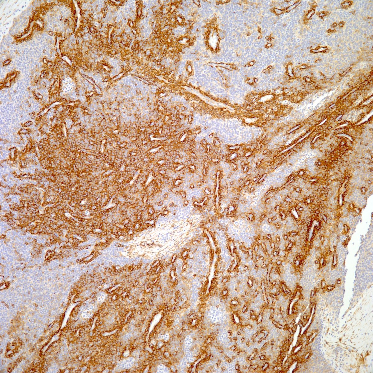 JMGardnerMD's tweet photo. Soft tissue mass in foot of adult. Actin+.
Answer ✅ https://t.co/VfJisy4jPd
H&E pics: https://t.co/QByyeSfpmJ.
Stains: https://t.co/D2lqveaI5J
#pathology #pathologists #pathTwitter #dermpath #dermatology #dermatologia #dermtwitter #BSTpath https://t.co/Ta91czpKsN