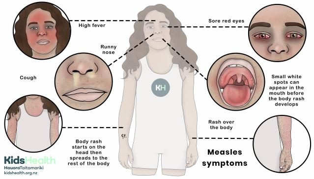 AB_drmd's tweet photo. ✅الحصبة أو measles هو مرض فيروسي شديد العدوى يسببه ال measles virus وينتقل عن طريق الرذاذ التنفسي respiratory droplets، ويعتبر من أكثر الأمراض المعدية اللي تعرفها البشرية لأن ال R0 تبعه عالي جدًا. 

المرض يبدأ بمرحلة تسمى prodrome فيها fever عالي مع ال 3 Cs وهي cough و coryza و conjunctivitis، وبعدها تطلع علامة مميزة جدًا داخل الفم اسمها Koplik spots وهي عبارة عن نقط بيضاء صغيرة على ال buccal mucosa، وبعدها يطلع ال rash المعروف اللي يبدأ من الوجه وينزل تحت للجسم بشكل تدريجي descending pattern. 

أهمية vitamin A هنا مرتبطة بشكل مباشر بالفيروس نفسه، لأن ال measles virus يسبب استنزاف سريع لمخزون vitamin A في الجسم، وهذا النقص يأثر بشكل مباشر على ال epithelial cells في العين وال respiratory tract وال GI tract، وبما إن vitamin A أساسي لسلامة الأغشية المخاطية ولدعم الجهاز المناعي، ف نقصه يزيد من شدة المضاعفات زي keratitis اللي ممكن توصل ل blindness، و يزيد خطر ال pneumonia وال diarrhea الشديد، وهذي أهم أسباب الوفاة عند الأطفال المصابين بالحصبة خصوصًا في الدول النامية. عشان كذا منظمة الصحة العالمية توصي بإعطاء جرعتين من vitamin A لكل طفل مصاب بالحصبة بغض النظر عن حالته التغذوية الأساسية، لأن هذي الجرعات أثبتت إنها تقلل من شدة المرض وتقلل نسبة الوفيات بشكل واضح وتسرع من تعافي ال epithelial tissue المتضرر.