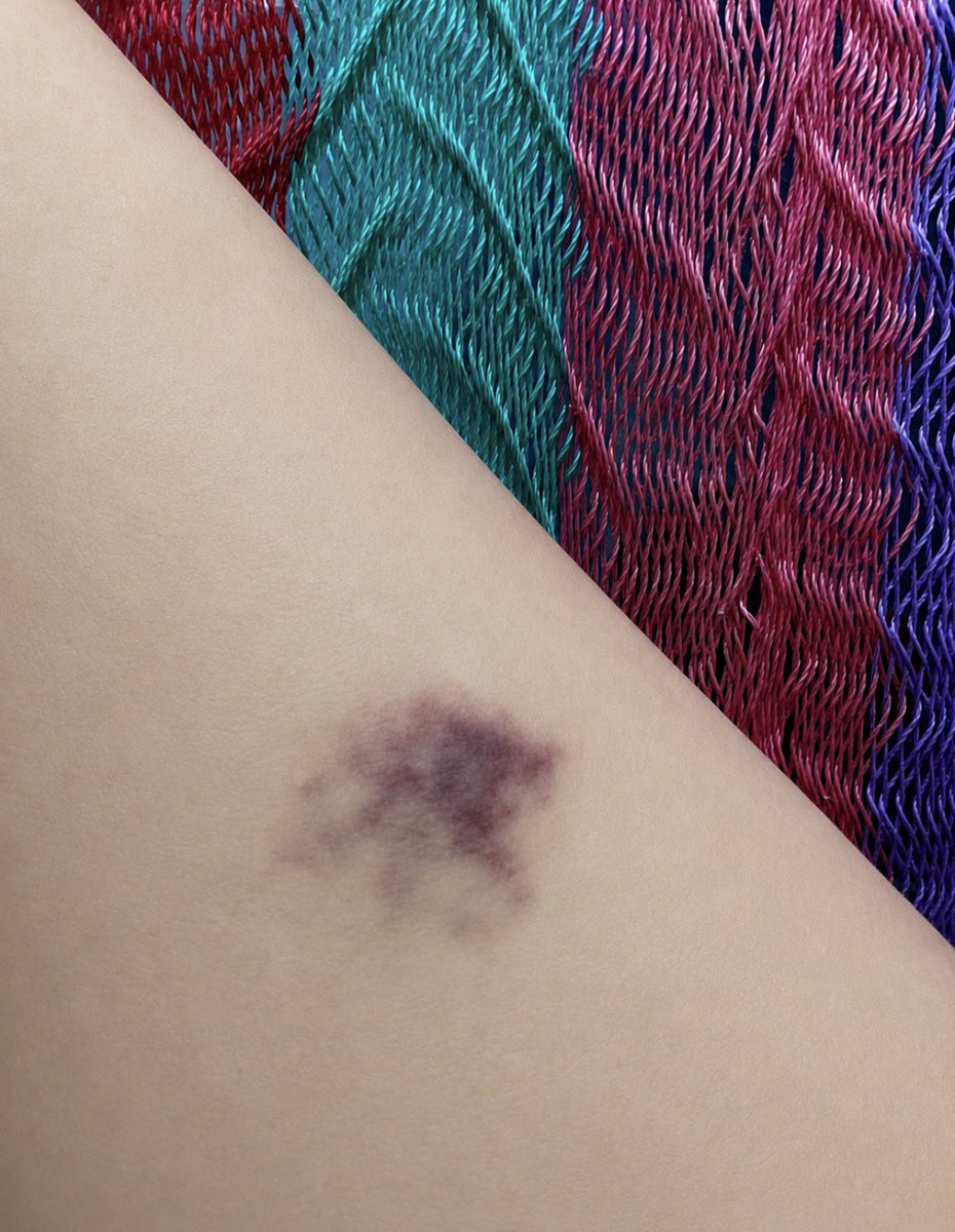 RuthZunza's tweet photo. ¿Cómo se llama médicamente cuando te sale un hematoma pero no te pegaste con absolutamente nada?
Mi cuerpo: genera un moretón de la nada para meterle drama a mi vida.
Yo: pero si no me golpeé .
#MoretonesMisteriosos
#Pielsensible
#Salud
#PreguntaSeria https://t.co/7DhEkMoM67