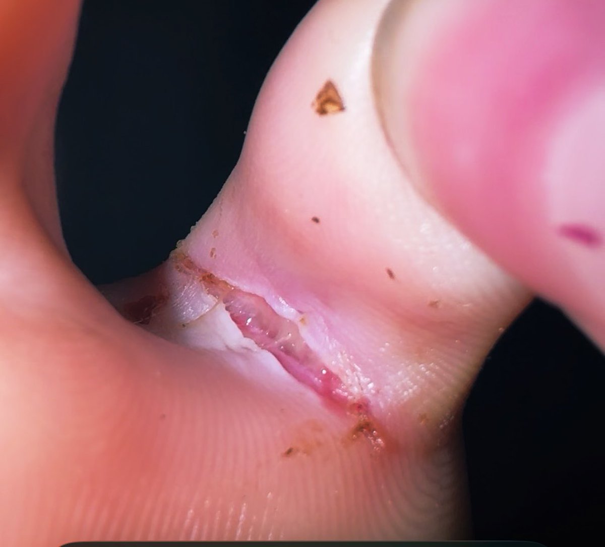 berdlythegoat1's tweet photo. im scared bru, i got a cut inbetween my pinky toe and it looks scary ๐ฅ (my toesy are a bit dirty mb)
#sos #cut #helpmeimgoingtodie https://t.co/nSzlnSGVIz