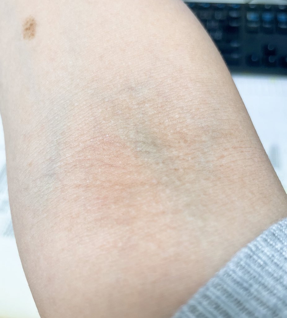 ayane730422's tweet photo. 100%注射で成功する血管

ただ利き手の方だから注射されるとその後の作業に影響するのが…
せめて反対の腕にして欲しかった😭😭 https://t.co/IADr9zzz4I