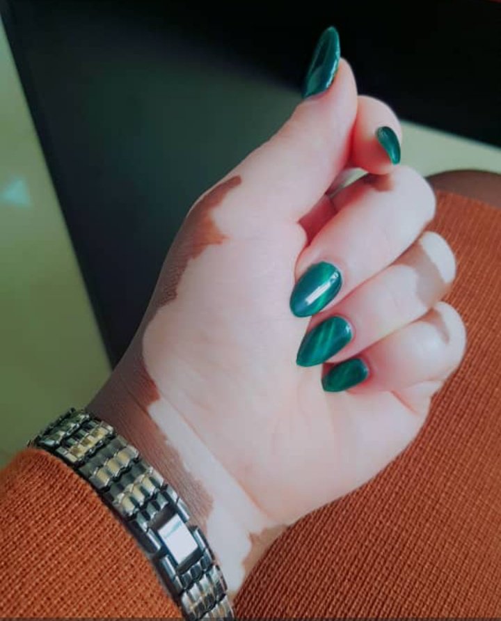 VAUorg's tweet photo. Vitiligo is not a curse, and it’s not a punishment. It’s an autoimmune skin condition where melanin cells are just less active. It doesn’t spread by touch, it doesn’t define your beauty, your health, or your future. https://t.co/OURv4al0Z0