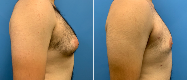 CosmetiCare's tweet photo. Before and after of Liposuction ✨

Schedule your consultation with one of our Board-Certified plastic surgeons today by calling 949-446-1542! https://t.co/5gxDwHIYNU