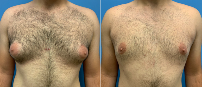 CosmetiCare's tweet photo. Before and after of Liposuction ✨

Schedule your consultation with one of our Board-Certified plastic surgeons today by calling 949-446-1542! https://t.co/dTT4otpnJs